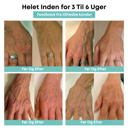 ÅreRo® - Åreknudeplaster