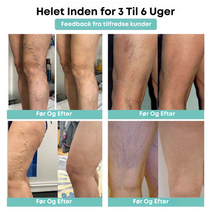 ÅreRo® - Åreknudeplaster